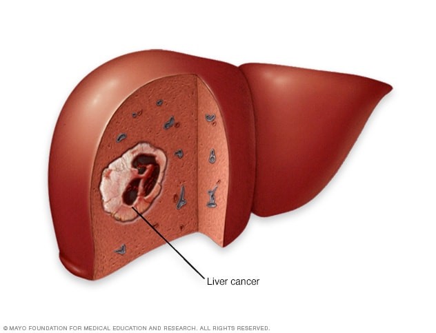What is liver cancer?